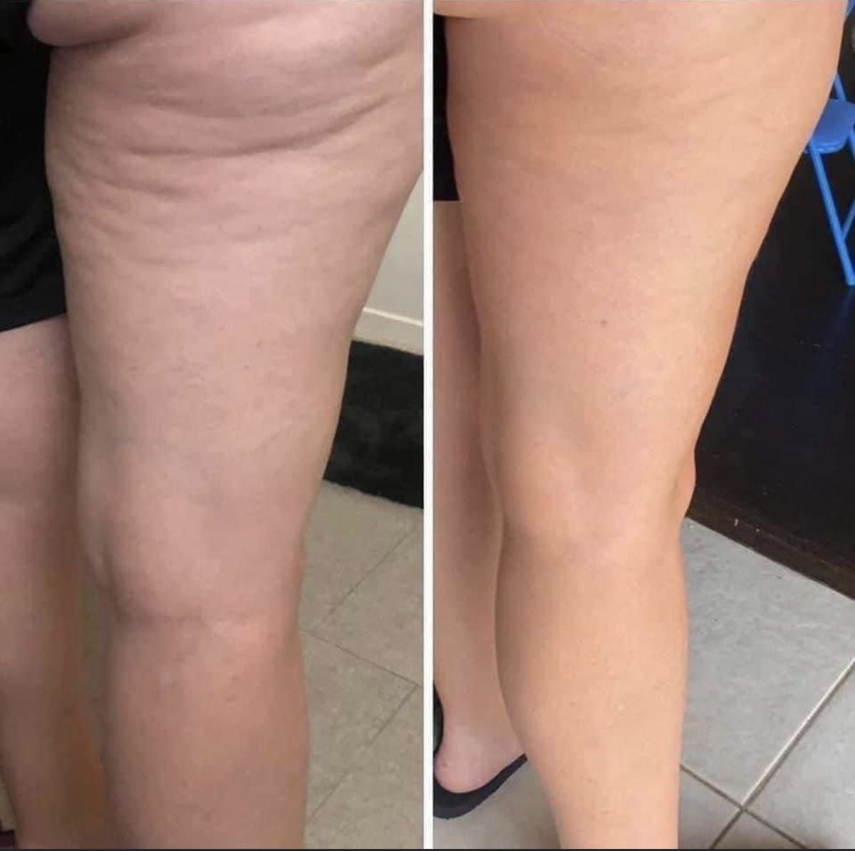 LPG lipomassage device for cellulite