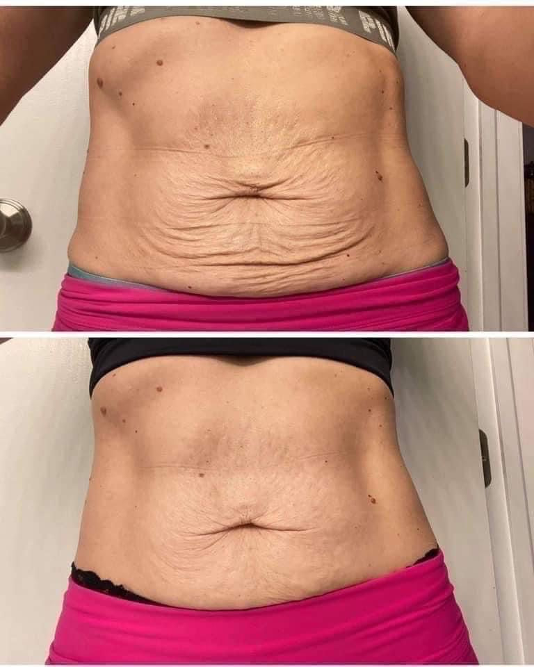 LPG lipomassage device for cellulite