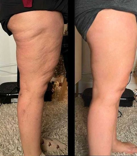 LPG lipomassage device for cellulite