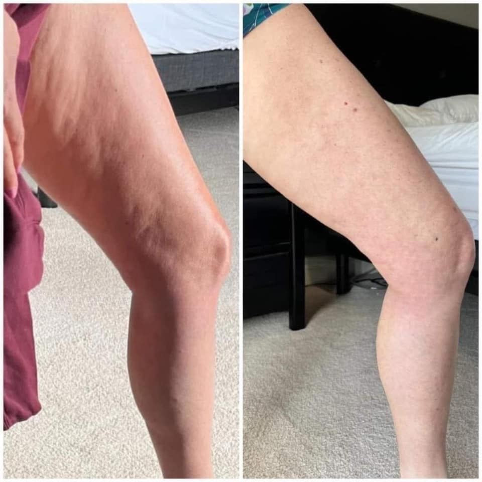 LPG lipomassage device for cellulite